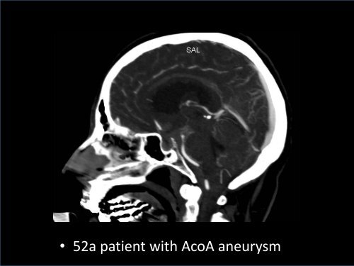 Cerebral Vasospasm after Subarachnoid Hemorrhage: Imaging with ...