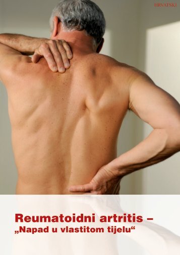 Reumatoidni artritis – - Ratiopharm