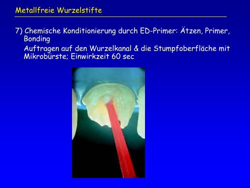 Aufbau von vitalen Zähnen