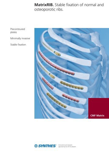 MatrixRIB. Stable fixation of normal and osteoporotic ribs. - Synthes