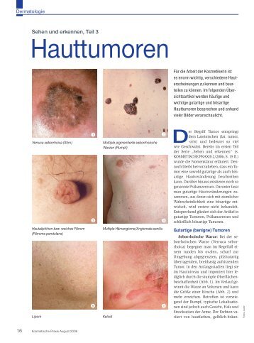 Hauttumoren - Beauty Forum