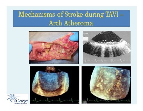 Stroke During TAVI: An Unmet Clinical Need? - Paragon Conventions