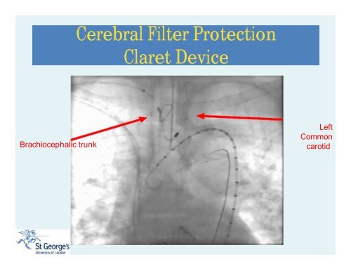 Stroke During TAVI: An Unmet Clinical Need? - Paragon Conventions