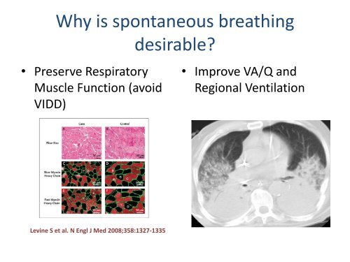 Spontaneous breathing during ARDS - Critical Care Canada Forum
