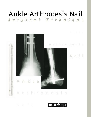 Ankle Arthrodesis Nail - Biomet