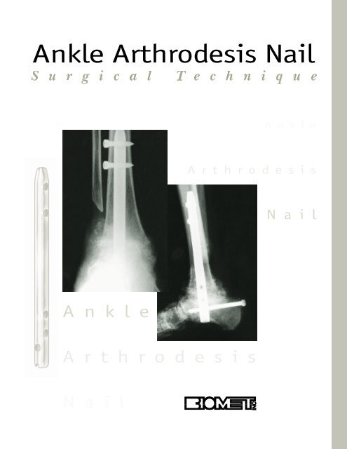 Ankle Arthrodesis Nail - Biomet
