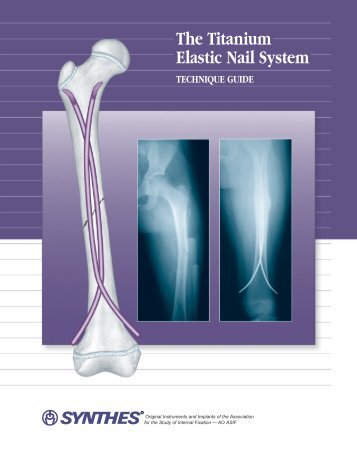 The Titanium Elastic Nail System Technique Guide