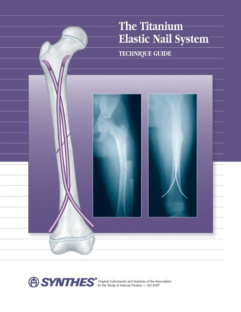 Prophylactic titanium elastic nailing (TEN) following femoral lengthening  (Lengthening then rodding) with one or two nails reduces the risk for  secondary interventions after regenerate fractures: a cohort study in  monolateral vs. bilateral