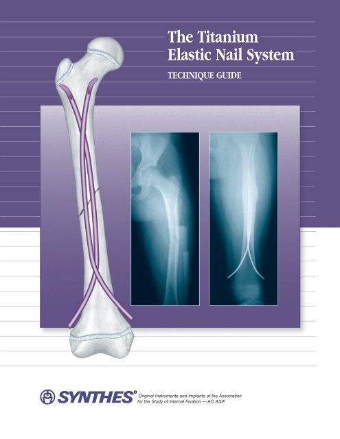 Frontiers | Novel Retrograde Tibial Intramedullary Nailing for Distal Tibial  Fractures