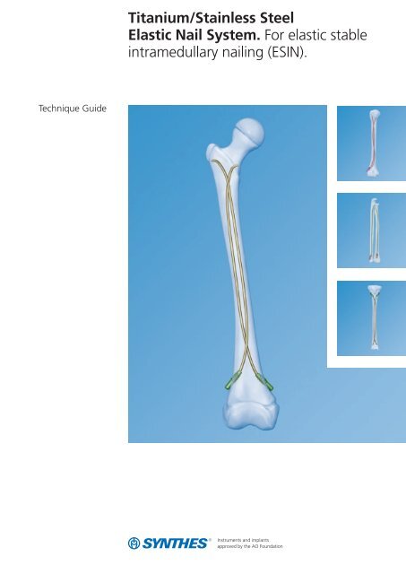 Figure 3 from Titanium elastic nail fixation for paediatric femoral and  tibial fractures. | Semantic Scholar