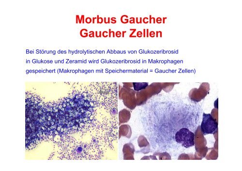 Knochen und Morbus Gaucher