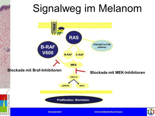 Melanom - Universitätsklinikum Essen