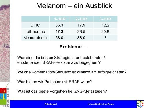 Melanom - Universitätsklinikum Essen