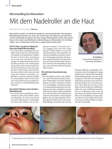 Microneedling bei Aknenarben - Mit  dem Nadelroller an die