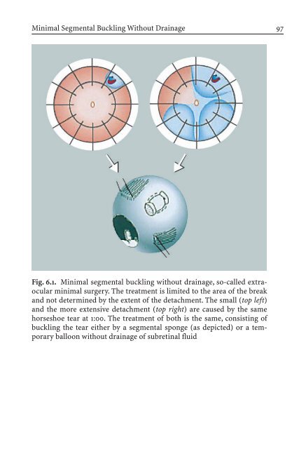 Primary Retinal Detachment