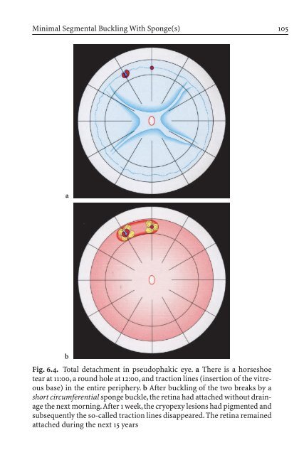 Primary Retinal Detachment
