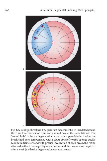 Primary Retinal Detachment