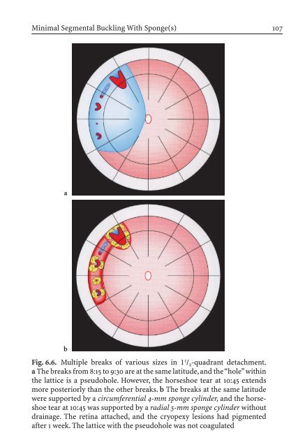 Primary Retinal Detachment