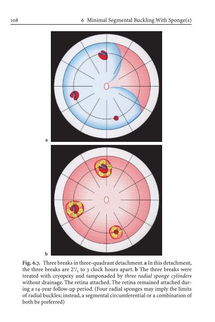 Primary Retinal Detachment