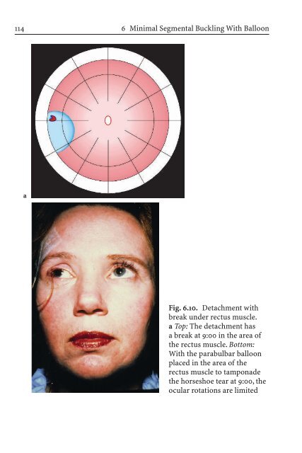 Primary Retinal Detachment