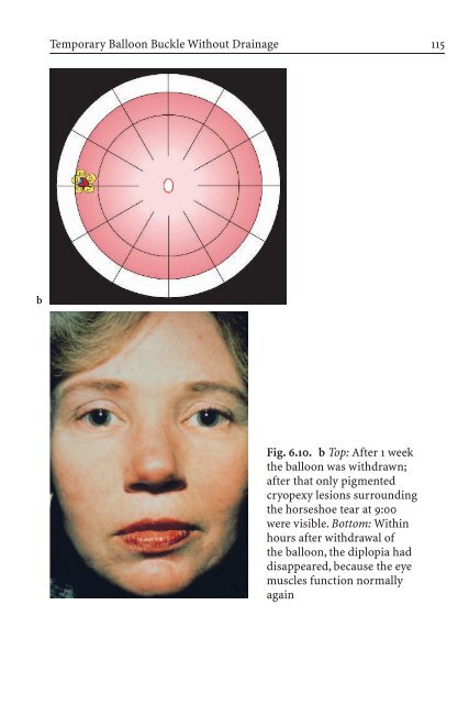 Primary Retinal Detachment