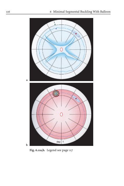 Primary Retinal Detachment