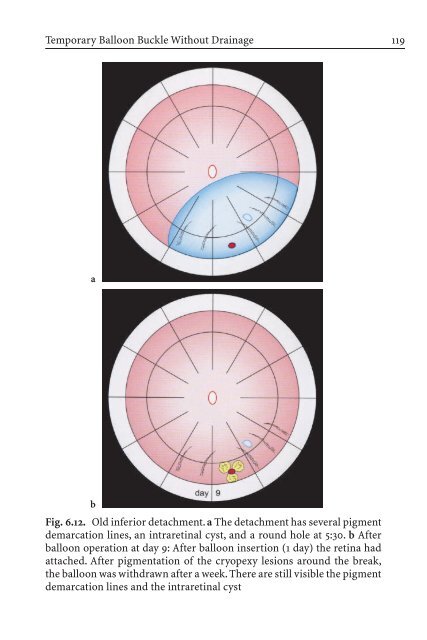 Primary Retinal Detachment