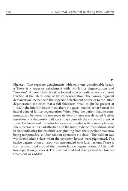 Primary Retinal Detachment