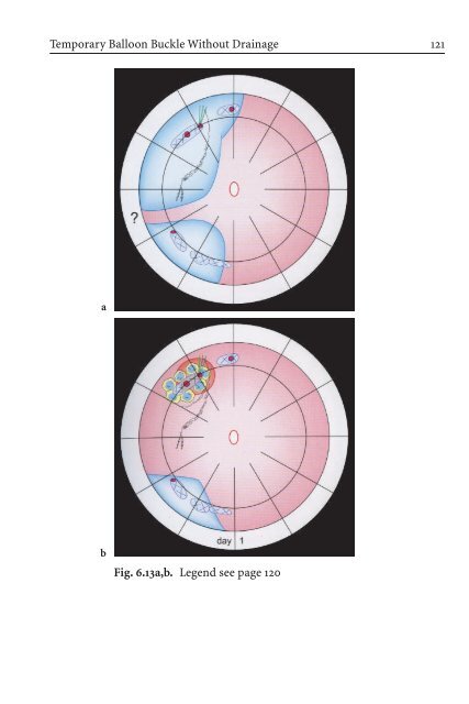 Primary Retinal Detachment