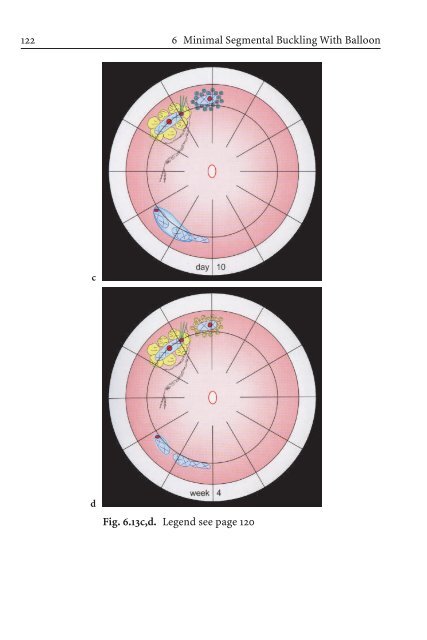 Primary Retinal Detachment