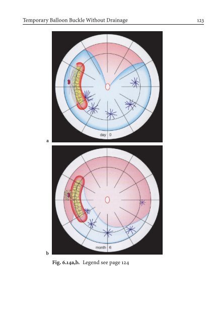 Primary Retinal Detachment