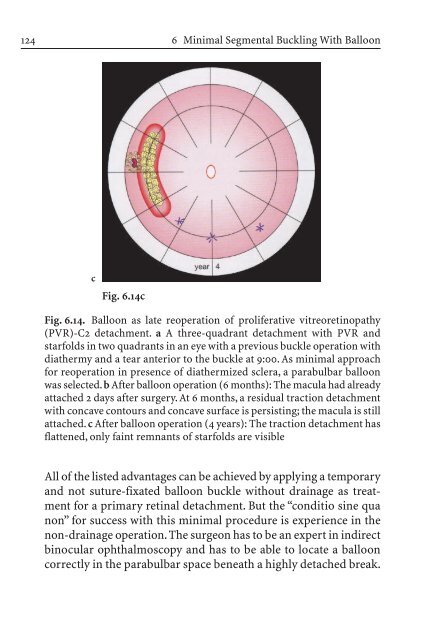 Primary Retinal Detachment