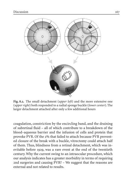 Primary Retinal Detachment