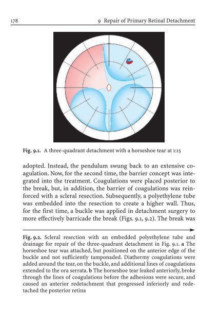 Primary Retinal Detachment