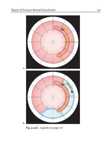 Primary Retinal Detachment