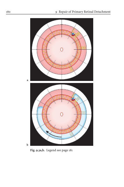 Primary Retinal Detachment