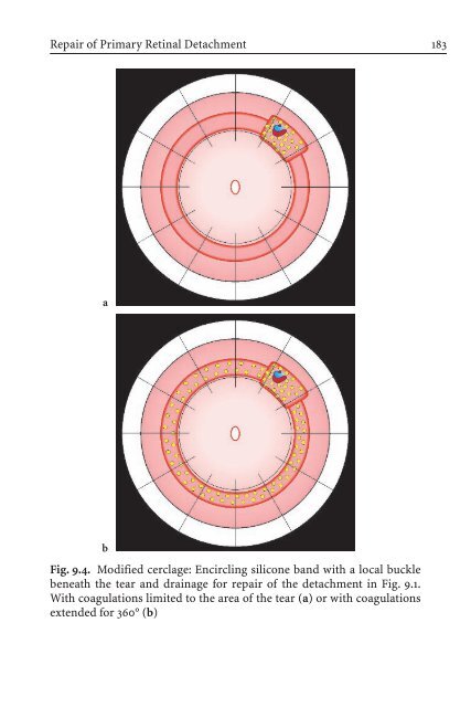 Primary Retinal Detachment