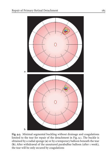 Primary Retinal Detachment