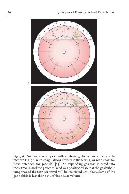 Primary Retinal Detachment