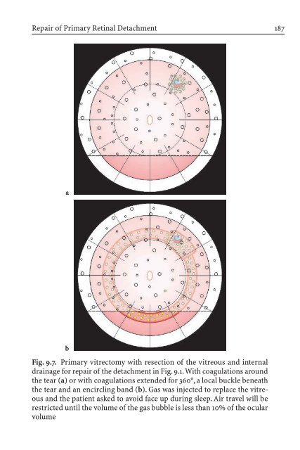 Primary Retinal Detachment