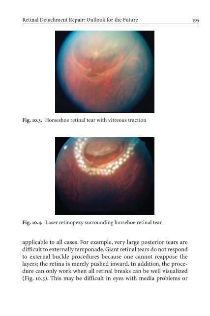 Primary Retinal Detachment
