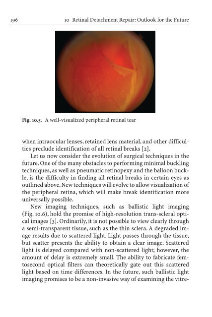 Primary Retinal Detachment