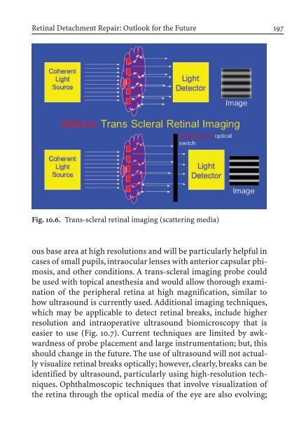 Primary Retinal Detachment