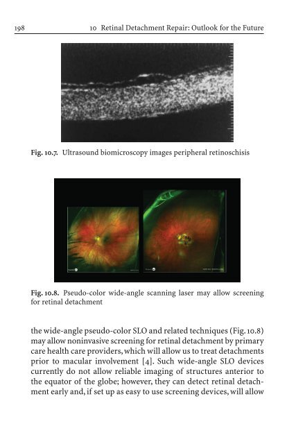 Primary Retinal Detachment