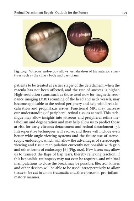 Primary Retinal Detachment
