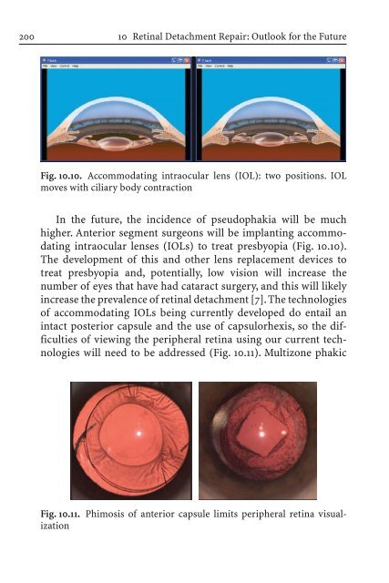 Primary Retinal Detachment