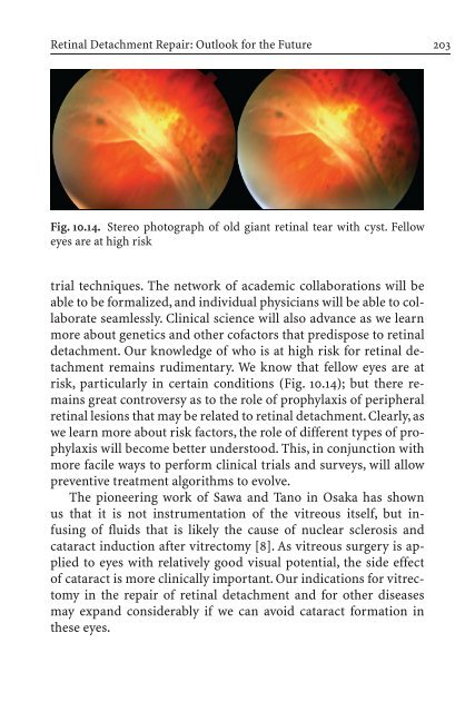 Primary Retinal Detachment