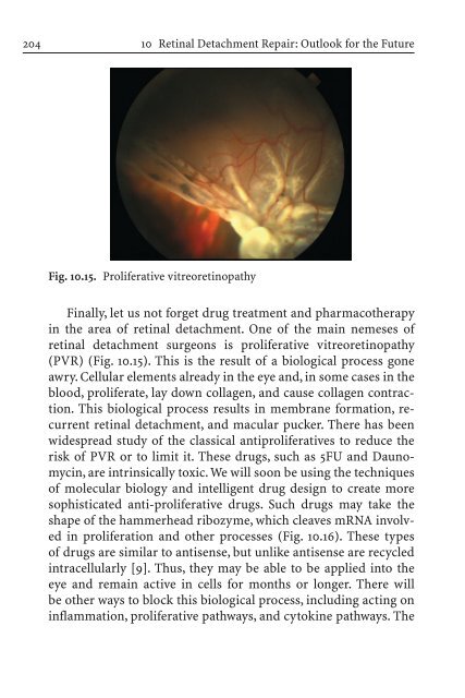 Primary Retinal Detachment