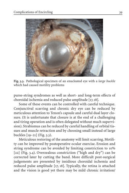 Primary Retinal Detachment