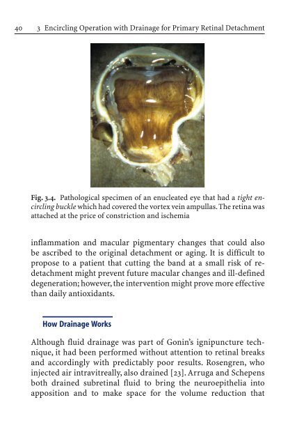 Primary Retinal Detachment